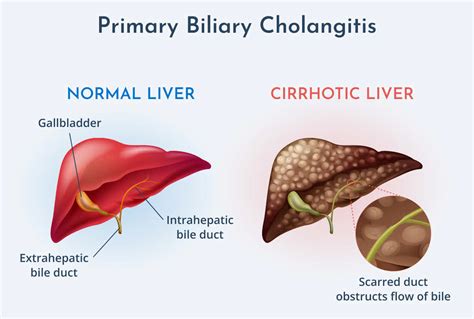 bile leakage symptoms|Cholangitis: Types, Symptoms, Treatment